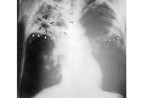 X-ray